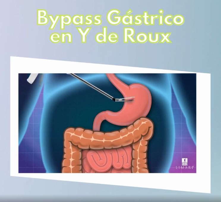 Bypass gástrico en Y de Roux