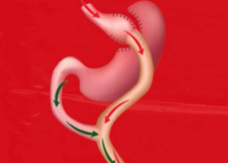 Cirugías de revisión: Redefiniendo tu camino a la salud