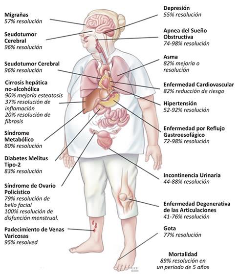 Cuáles son concretamente los beneficios de la cirugía bariátrica?