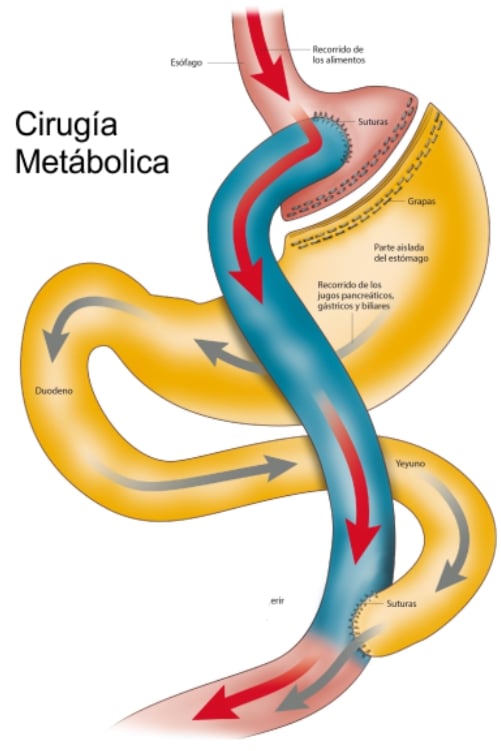 Diabetes 2 y obesidad