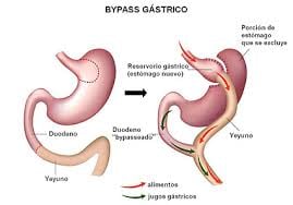 Efectos secundarios y beneficios de la cirugía de la obesidad