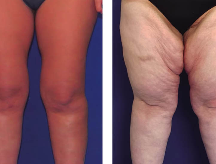 Inflamación crónica y obesidad: ¿cómo ayuda la cirugía?