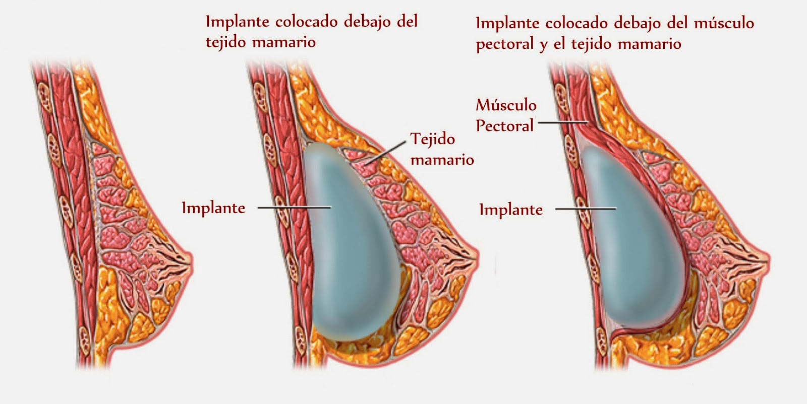 Mamoplastia con prótesis