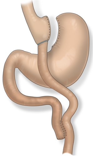 Qué ocurre durante el bypass gástrico laparascópico? Qué ocurre durante el bypass gástrico laparascópico?