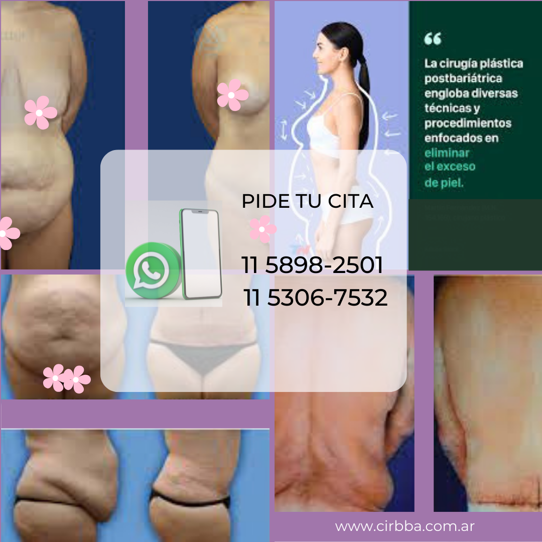 Qué es y quién debe realizarse una cirugía post bariátrica?