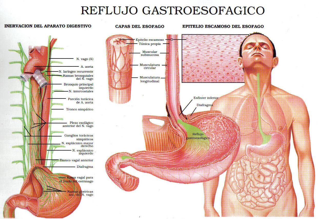 Enfermedad por reflujo gastroesofágico