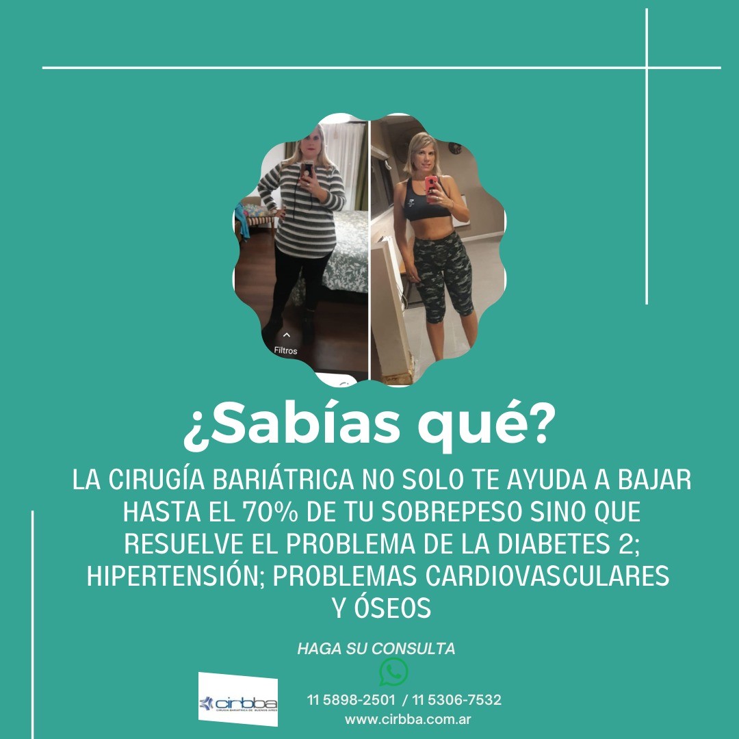 Sabías esto de la cirugía bariátrica?